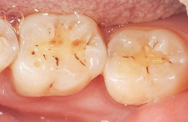 図2　アマルガムと二次う蝕を除去。周辺の着色部位の削除の判断は患者の年齢やリスクファクター、ダイアグノデント ペンの数値を参考にMIな窩洞に努めた。