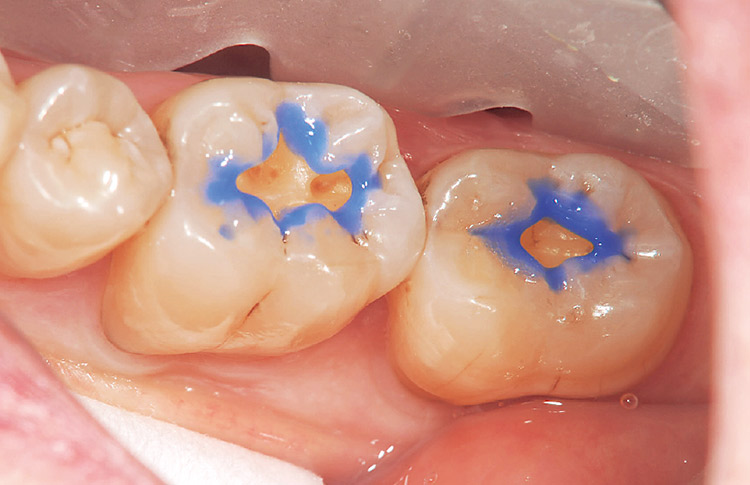 図5　未切削エナメル質部分には、リン酸エッチングを行う。