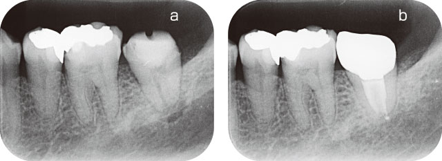 左下第二大臼歯の根管充填の写真