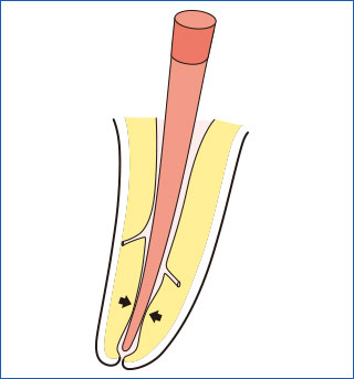 根管形成のテーパーが不十分な場合の図
