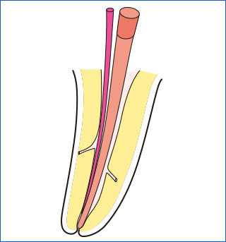 根管形成のテーパーより若干細めの場合の図