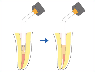 ダイアガンによる根管上部の根管充填の図