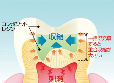 充填材料の収縮による疼痛イメージ