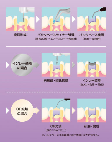 バルクベース操作ステップ図