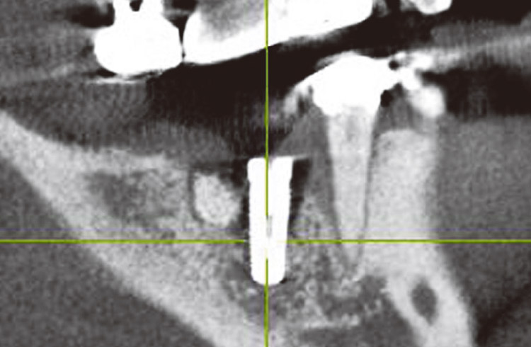 図12　右下6番　インプラント埋入後（矢状断）。