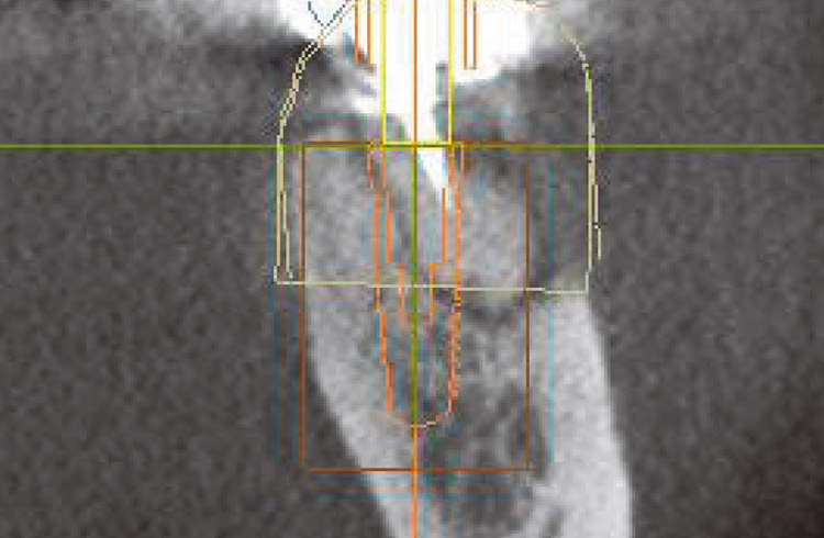 図13　右下6番　術前シミュレーション画像（冠状断）。