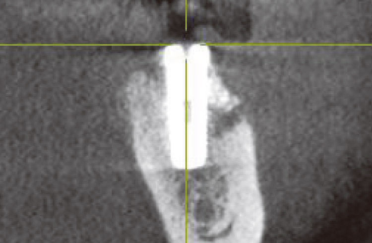 図14　右下6番　インプラント埋入後（冠状断）