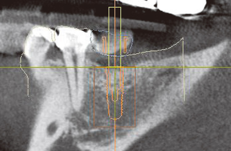 図15　左下6番　術前シミュレーション（矢状断）。