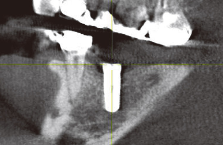 図16　左下6番　インプラント埋入後（矢状断）。