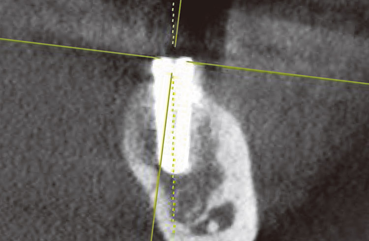 図18　左下6番　インプラント埋入後（冠状断）。