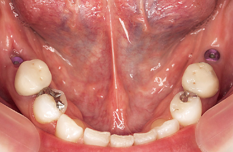 図19　2ヵ月後の歯肉治癒