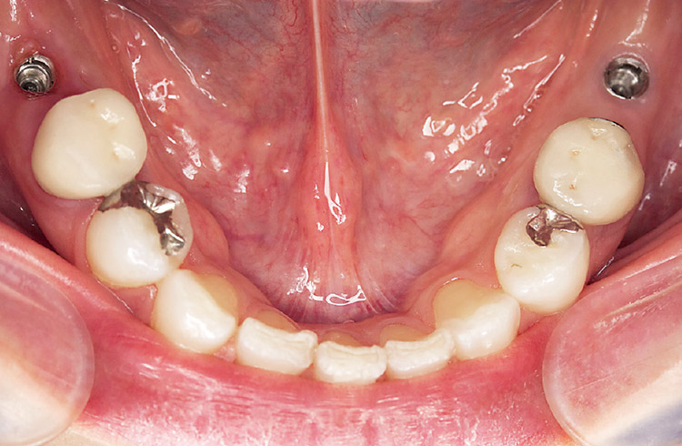 図23　アバットメントと最終補綴物装着前の口腔内