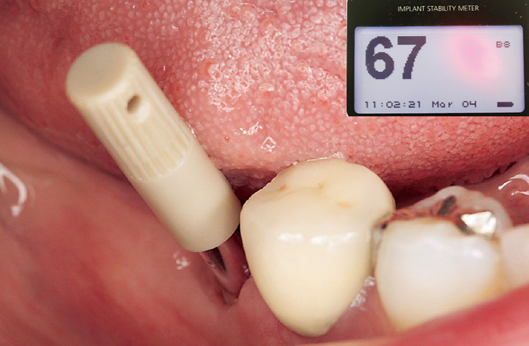 図24　右下6番　オステルISQアナライザにてインプラント安定性を測定。