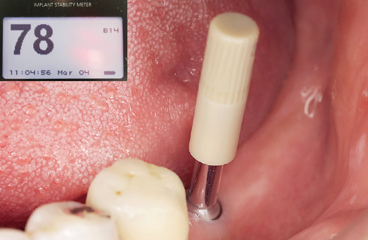 図25　左下6番　オステルISQアナライザにてインプラント安定性を測定。