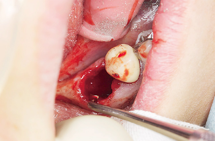 図3　抜歯後念入りに掻爬を行った。