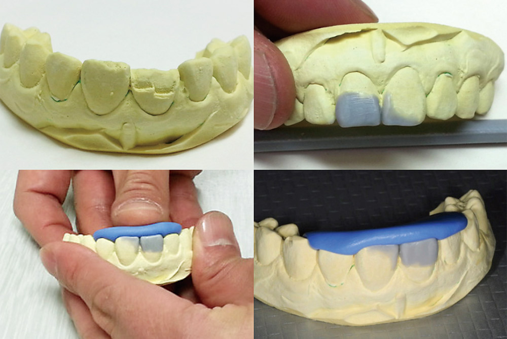 図2　破折した患歯の印象を行い模型におこした上で最終形態をワックスアップによりシミュレーションする。シリコン印象材のパテタイプを用いてシリコンガイドを作製する。即日修復を行わない場合は、破折部には仮充填を施した上で次回までにシリコンガイドを用意しておく。