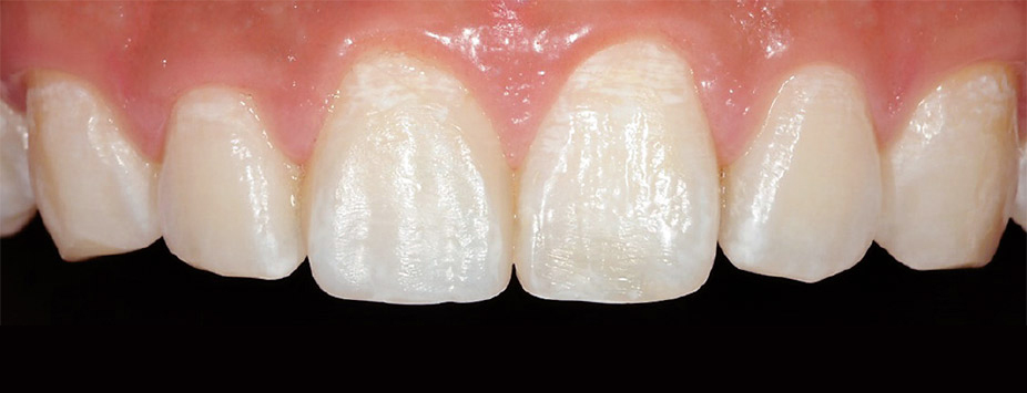 図6　修復直後の唇側面観。コンポジットレジンの半透明性により修復歯の透明感が天然歯同様に再現されている。