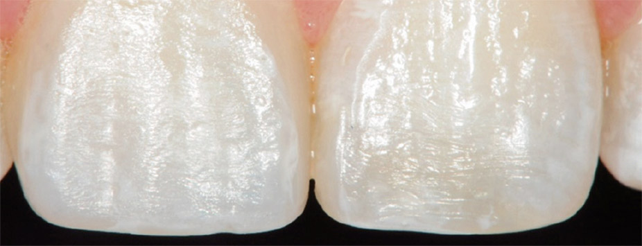 図7　解剖学的特徴を踏まえて周波条などのディテールを再現し、丁寧な研磨により天然歯に類似した光沢感と透明感を修復物に与える。