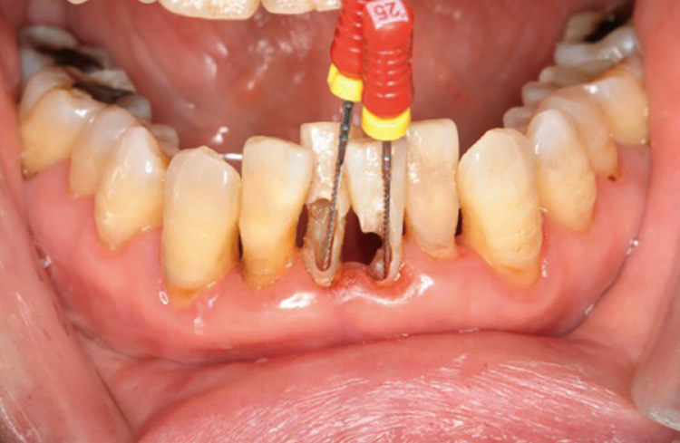 図3 歯冠部切縁側はそのまま温存することとした。