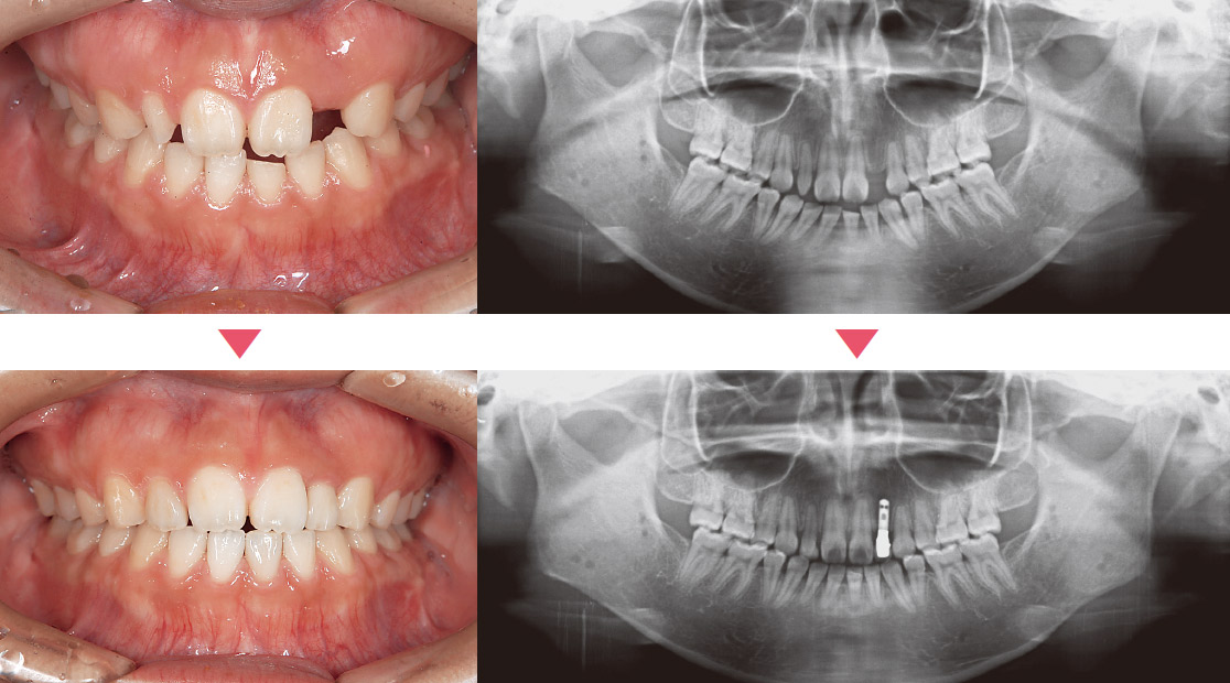 20歳女性、2 矮小歯、2 先欠、１切端破折、が認められる。2 にクラウン、2 にインプラント、1 はラミネートベニアにて対応した。最初の治療で最大の効果が得られたと思われる