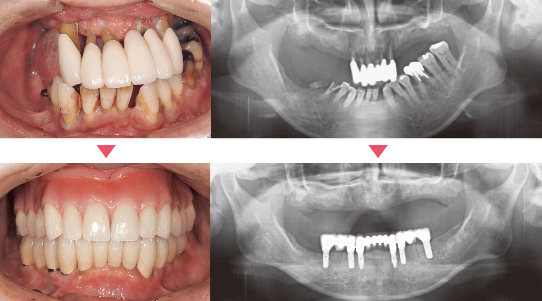 18本の歯が存在するがほとんど噛めない状況である。下顎に6本のインプラントを用い、上顎は総義歯とした。天然歯は1本も存在しないが咀嚼が充分できる状況となった。