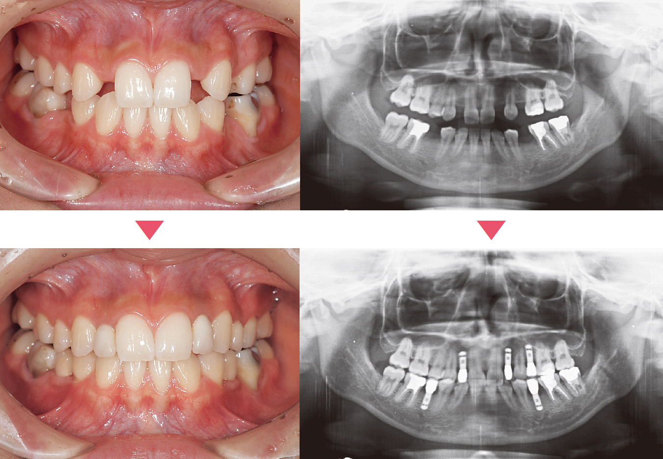 先天性欠損9本があり欠損部5本となっている。5本のインプラントを用い隣在歯を削ることなく処置ができた。