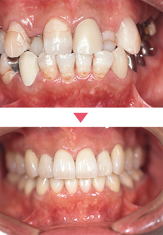 矯正、インプラント、審美修復をおこなうことにより全体のバランスを取ることが重要である。