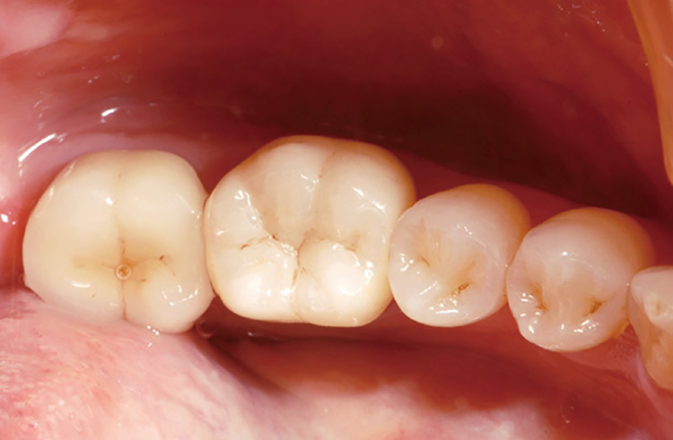 図11　ML A-Darkを使用し研磨仕上げしたクラウンは、ややエナメル領域が明るいものの、視覚的に大きな問題はない。