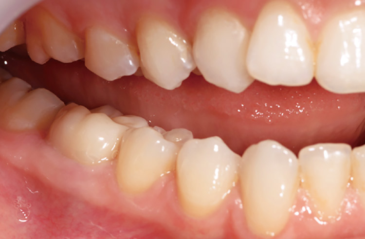 図13　ML A-Lightを使用し、研磨仕上げしたクラウンを装着した別の患者の術後所見（6 ）。