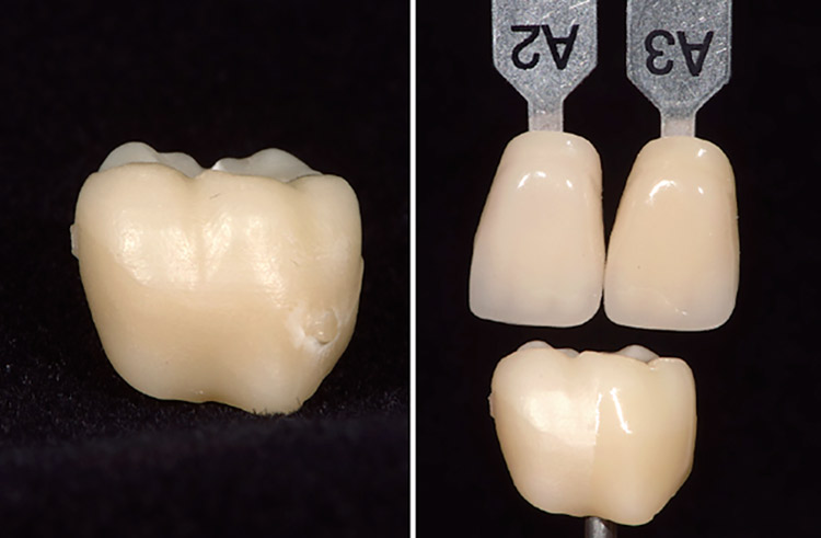 図4　切削加工後、シンタリングの終了したML ADark使用のクラウン（左側）。右側は表面をステインリキッドで濡らすことで目標シェードに近いかどうかを確認しているところ。ここでは、クラウンの右側半分にステインリキッドを塗布している。