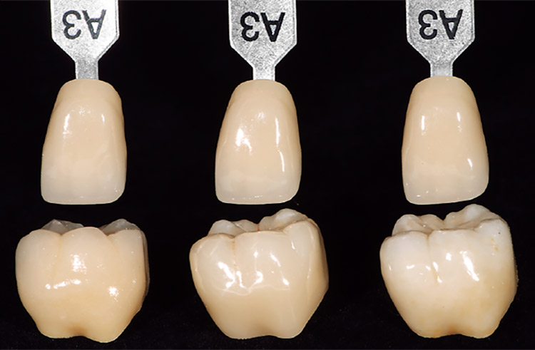 図5　カタナコーピングにCZRを焼き付けて完成したクラウン（左）、ML A-Darkを使用し研磨仕上げしたクラウン（中）、ML A-Lightを使用し、CZRプレス-LFエクスターナルステインにて着色したクラウン（右）。