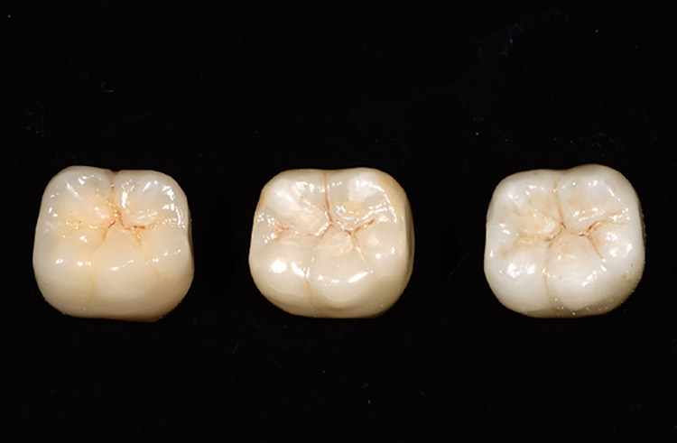 図6　同咬合面観。左端のCZRを焼き付けたクラウンは、特にエナメル質領域では天然歯と近似したポーセレン特有の透明感が再現されている。中のものはエナメル質領域ではジルコニア特有の屈折率による白さが反映される。右端はエナメル質領域の比較観察では最も白い。