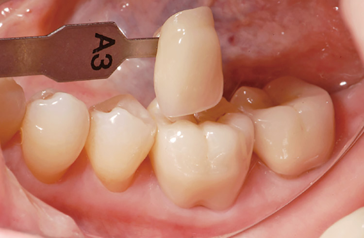 図8　ML A-Darkを使用し研磨仕上げしたクラウンの口腔内試適。