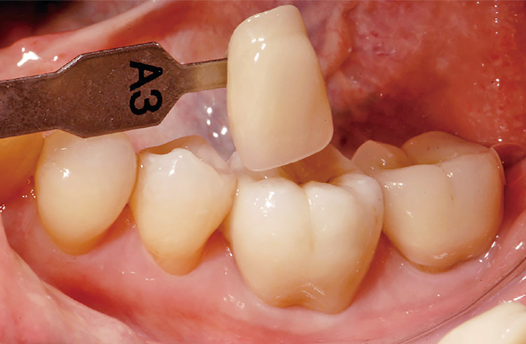 図9　ML A-Lightを使用し、CZRプレス-LFエクスターナルステインにて着色したクラウンの口腔内試適。