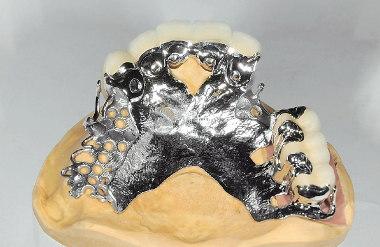 図5　前歯部はレストを連結し、臼歯部は軸壁を延長したマイナーコネクターとプロキシマルプレートのコンビネーションメタルフレームワークである。