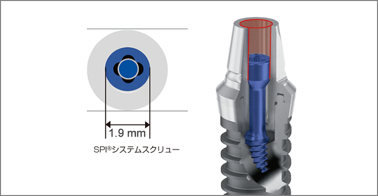 スクリューヘッドが小さいので、アバットメントの厚みを維持でき、強度が増す。