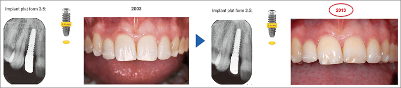 直径サイズの小さなインプラントでの良好な長期結果（写真提供：Dr. Ueli Grunder, Zurich）。