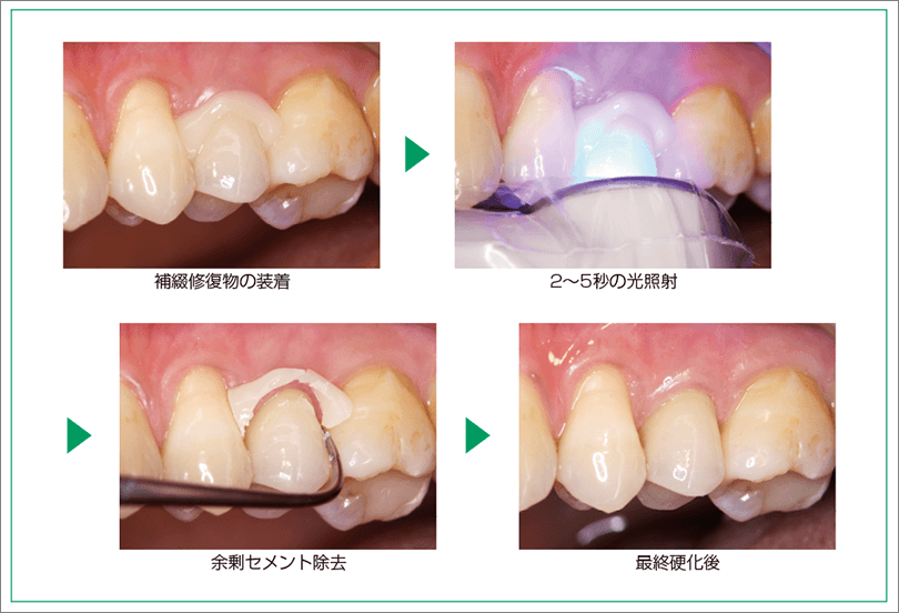 タックキュアによる余剰セメント除去のステップ<br />（写真提供：高輪歯科DCC&DSS 加藤 正治 先生）