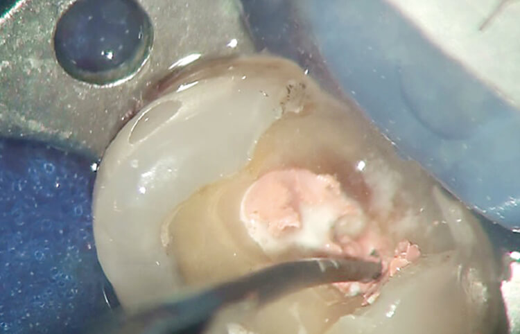 59歳女性の上顎左側第一小臼歯の再根管治療。アンカーチップをガッタパーチャ内部に挿入して振動させる。
