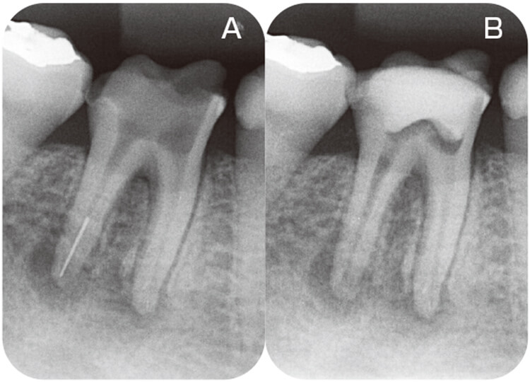 術前(A)とファイル除去後(B)のデンタルX線写真。ファイル除去操作による根管拡大はほとんどなかった。