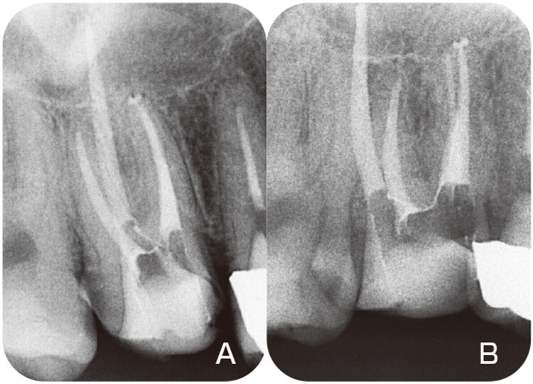 根管充填確認のための正放線(A)と偏遠心撮影(B)。MB2は歯根中央部で分岐していた。