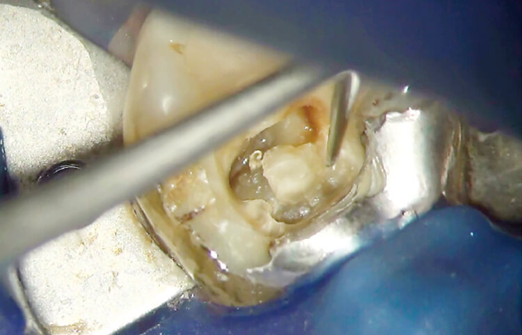 47歳女性の下顎右側第一大臼歯の感染根管治療。顕微鏡下で残存天蓋を超音波チップで削除した。