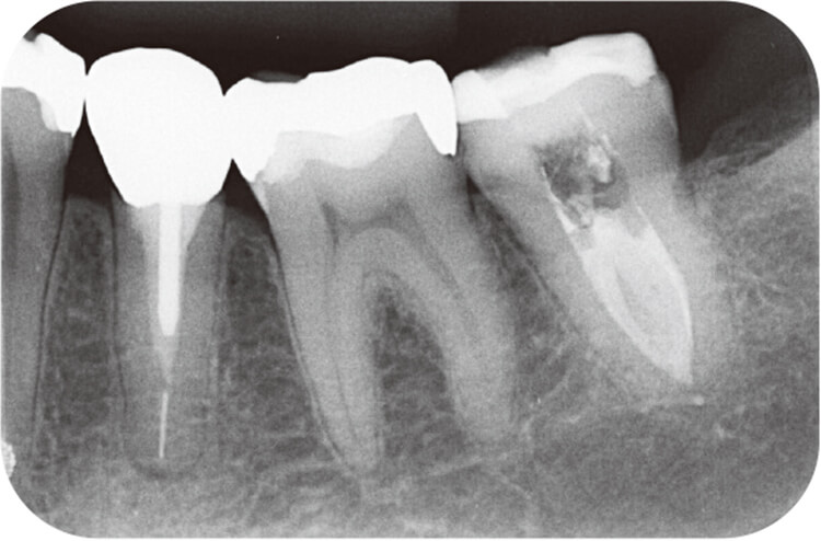根管充填するとイスマス内にも根管充填材が広がって充填されていた。