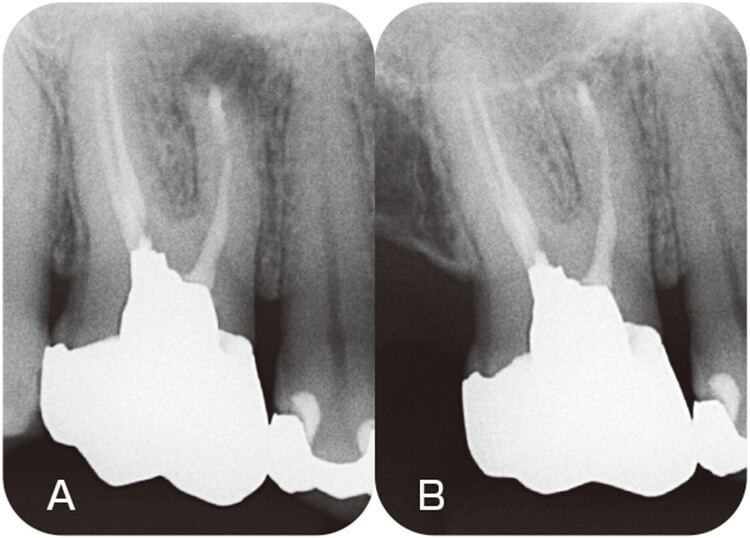 38歳男性の上顎第一大臼歯。瘻孔のために逆根管治療を行った。術後に瘻孔は消失し、術直後の根尖部透過像(A)は1年6ヵ月後に消失している(B)。