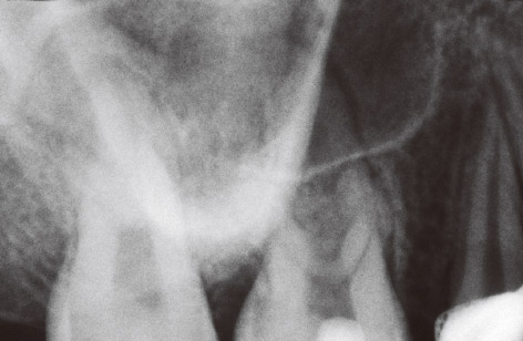 図1　上顎右側第一大臼歯のデンタルX線写真。