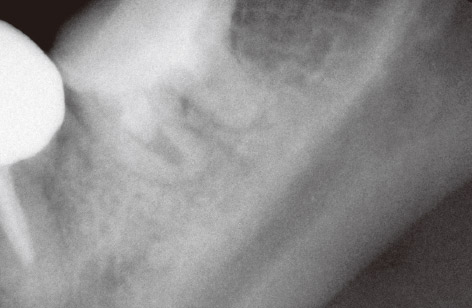 図7　根尖部の感染歯質をマイクロエキスカで丹念に掻き出しては超音波吸引洗浄し、感染源を徹底的に除去するとともに、2本目のファイルも除去した。