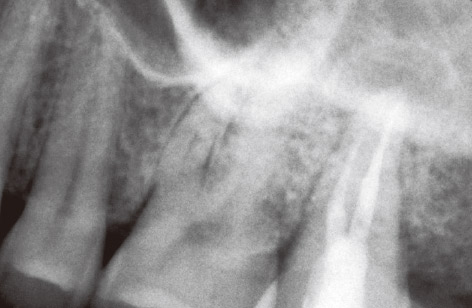 図8　抜髄後2年以上自発痛の続く上顎左側第二大臼歯のデンタルX線写真。
