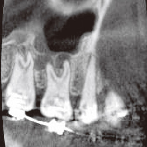 図2A 矯正用インプラントアンカー埋入のため撮像した（管電流3mA）。