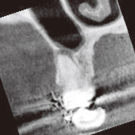 図2B 同・前頭断（近心頰側根）：根は根尖部で2根管に分岐している。