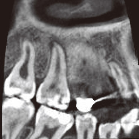 図2C 同・矢状断（口蓋根）：歯根膜腔の拡大が認められる。